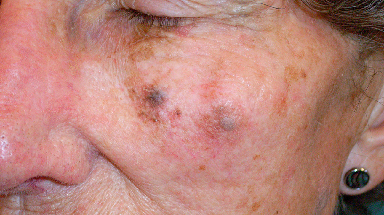 Cẩn thận với những điểm bất thường trên gương mặt có thể là dấu hiệu ung thư da - Ảnh 5.
