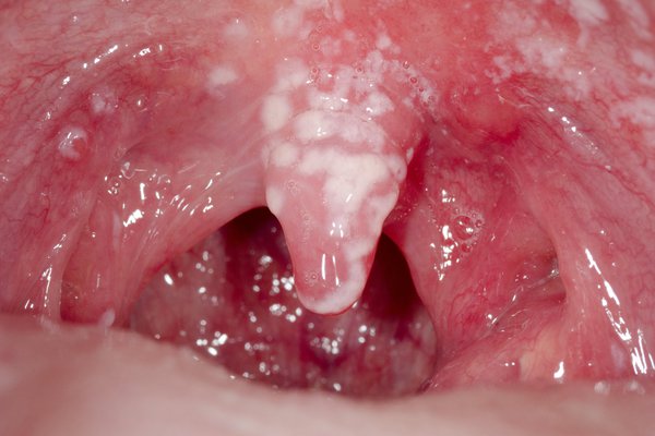 Cách phân biệt nấm miệng và nhiệt miệng ở trẻ - Ảnh 5.