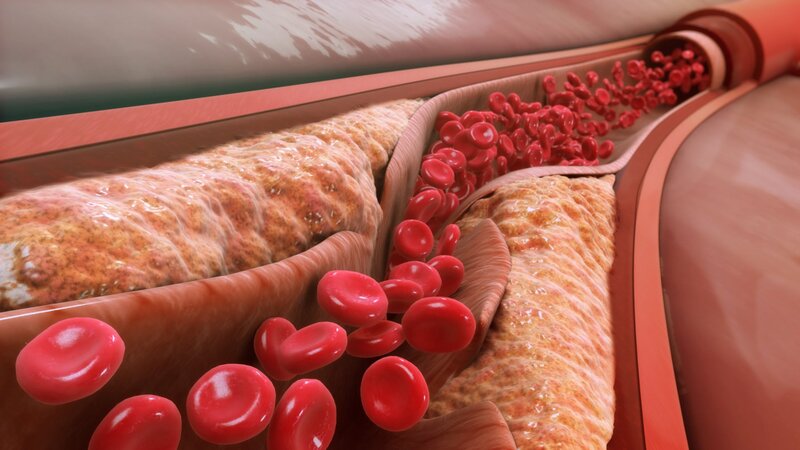 Khi “vòng 3” xuất hiện thứ này thì coi chừng cholesterol tăng vọt, phát hiện sớm càng ít bệnh - Ảnh 1.