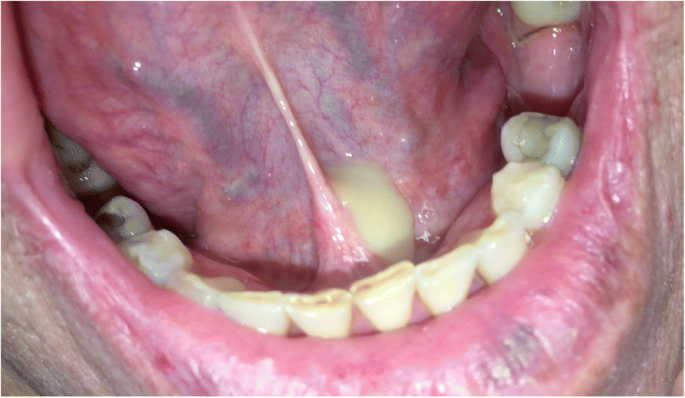 Sưng viêm tuyến nước bọt, có mủ trong miệng do đâu?- Ảnh 4.