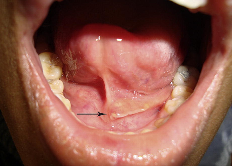 Sưng viêm tuyến nước bọt, có mủ trong miệng do đâu?- Ảnh 3.