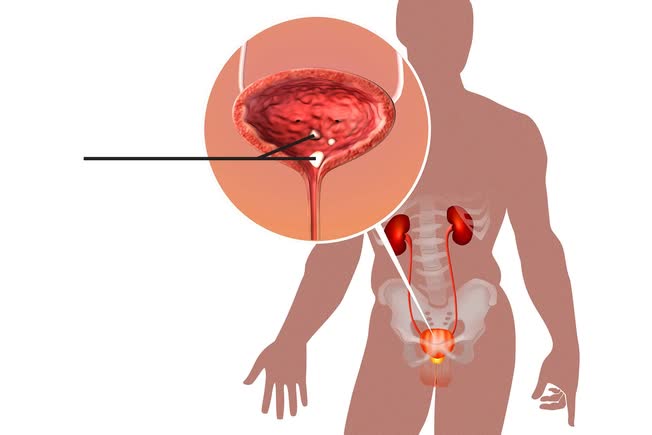 9 vị trí cơ thể có thể "mọc sỏi" và những gì bạn cần biết- Ảnh 3.