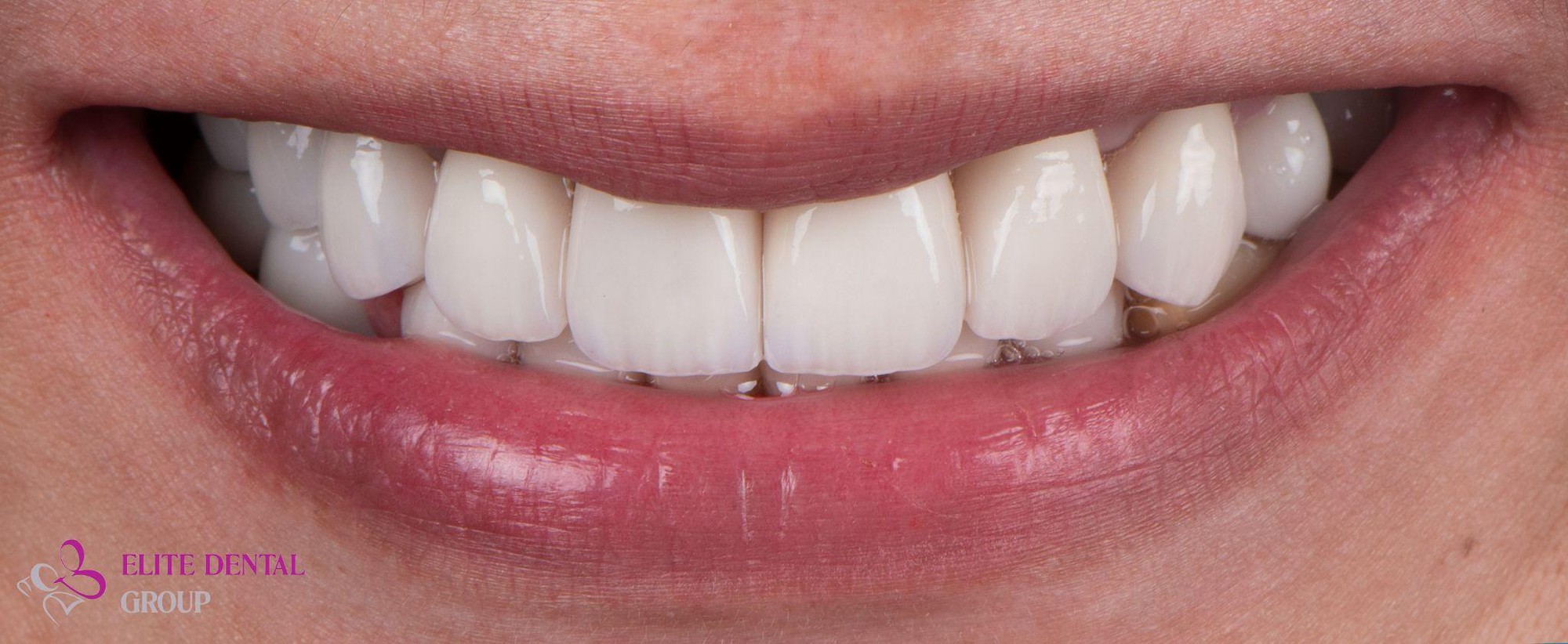 Đẹp mà an toàn: Những điều cần biết khi lựa chọn làm răng sứ thẩm mỹ- Ảnh 2.
