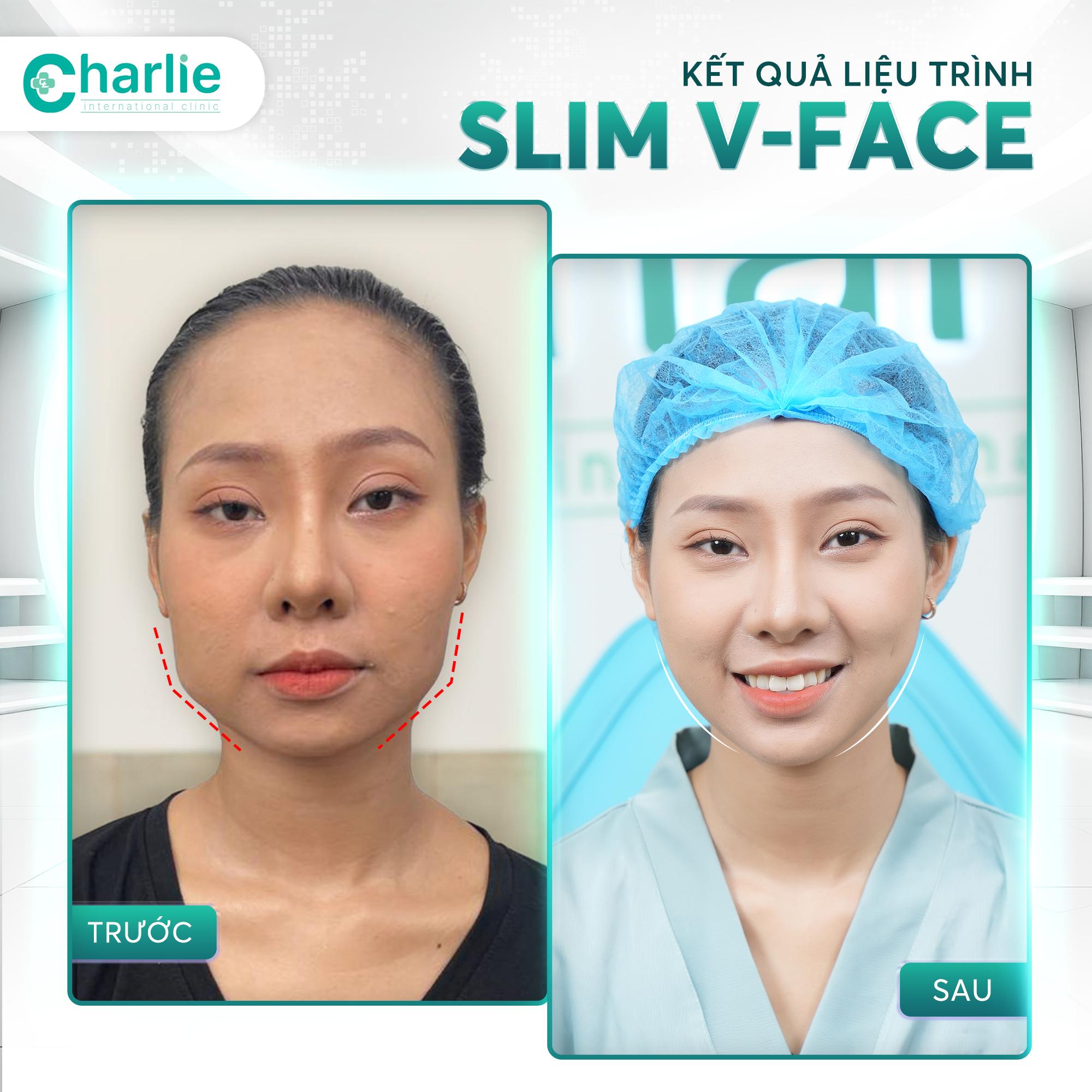Phòng khám Charlie tiên phong công nghệ Thon gọn hàm Slim V-Face không cần phẫu thuật- Ảnh 3.
