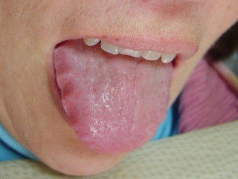 Lưỡi vỏ sò là gì? Lưỡi vỏ sò cảnh báo gì về tình trạng sức khỏe của bạn- Ảnh 4.