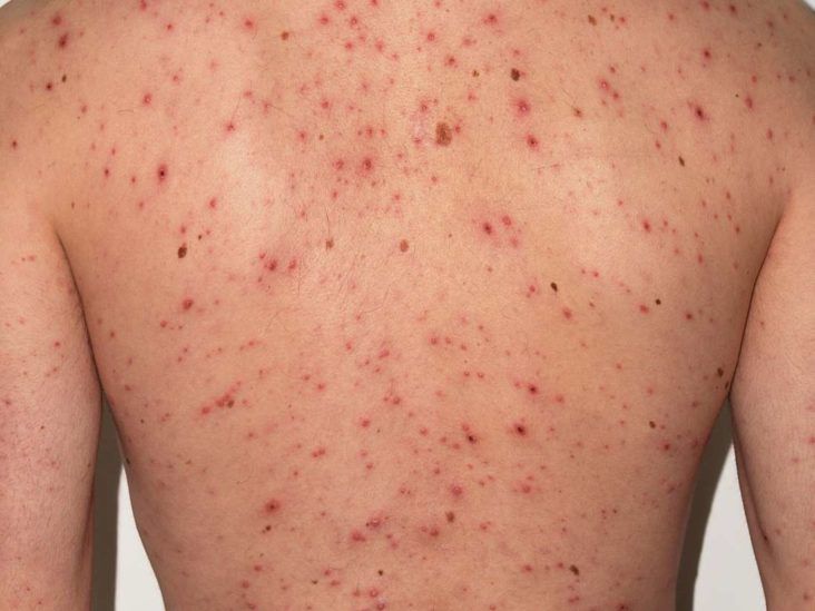 7 bệnh gây phát ban, mẩn ngứa da do virus cần lưu ý trong mùa hè này- Ảnh 8.