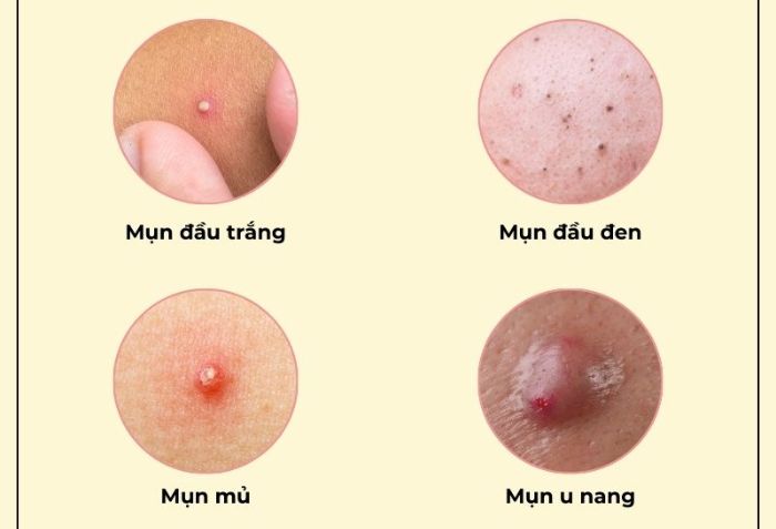 Mụn và mụn thịt: Sự khác biệt và cách điều trị an toàn bạn cần biết- Ảnh 1. Mụn và mụn thịt: Sự khác biệt và cách điều trị an toàn bạn cần biết- Ảnh 1.