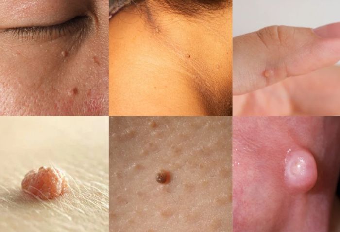 Mụn và mụn thịt: Sự khác biệt và cách điều trị an toàn bạn cần biết- Ảnh 3. Mụn và mụn thịt: Sự khác biệt và cách điều trị an toàn bạn cần biết- Ảnh 3.
