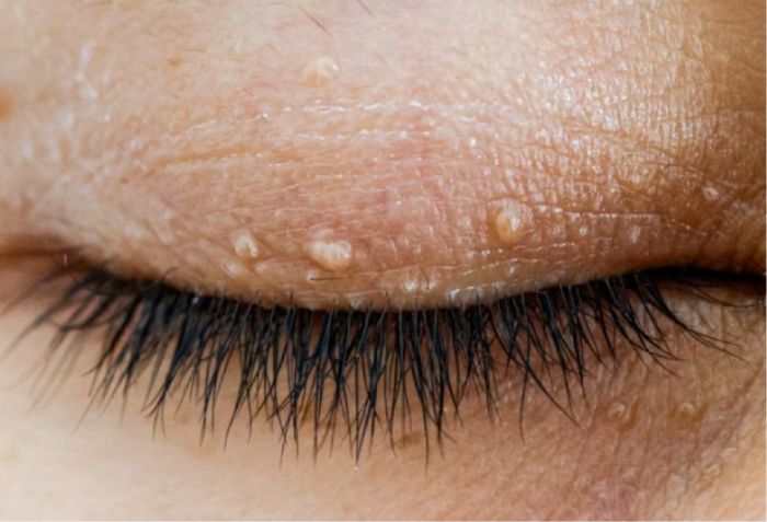 Mụn và mụn thịt: Sự khác biệt và cách điều trị an toàn bạn cần biết- Ảnh 2. Mụn và mụn thịt: Sự khác biệt và cách điều trị an toàn bạn cần biết- Ảnh 2.