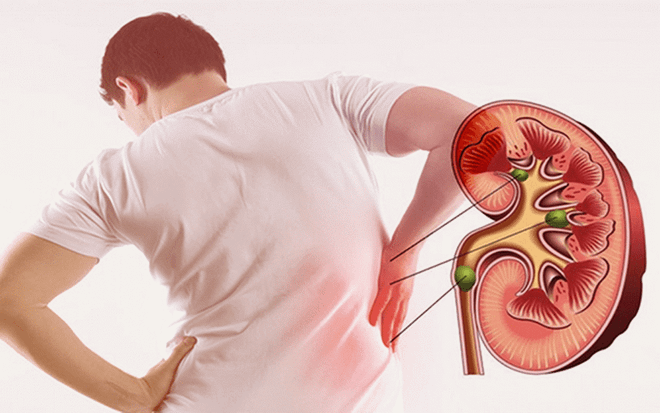 Bệnh sỏi thận và những biến chứng nguy hiểm không thể chủ quan- Ảnh 1. Bệnh sỏi thận và những biến chứng nguy hiểm không thể chủ quan- Ảnh 1.