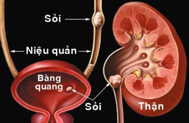 Bệnh sỏi thận và những biến chứng nguy hiểm không thể chủ quan- Ảnh 2. Bệnh sỏi thận và những biến chứng nguy hiểm không thể chủ quan- Ảnh 2.