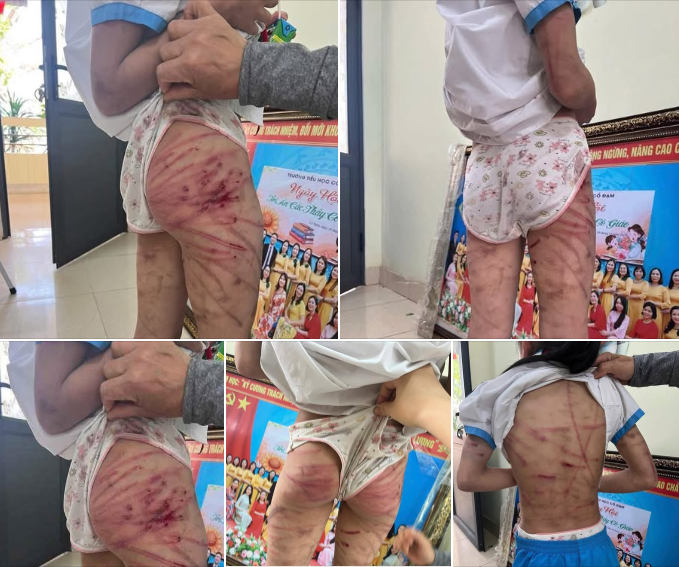 Đưa bé gái bị cha dượng bạo hành ở Hà Tĩnh về quê ngoại Sơn La sinh sống- Ảnh 1. Đưa bé gái bị cha dượng bạo hành ở Hà Tĩnh về quê ngoại Sơn La sinh sống- Ảnh 1.