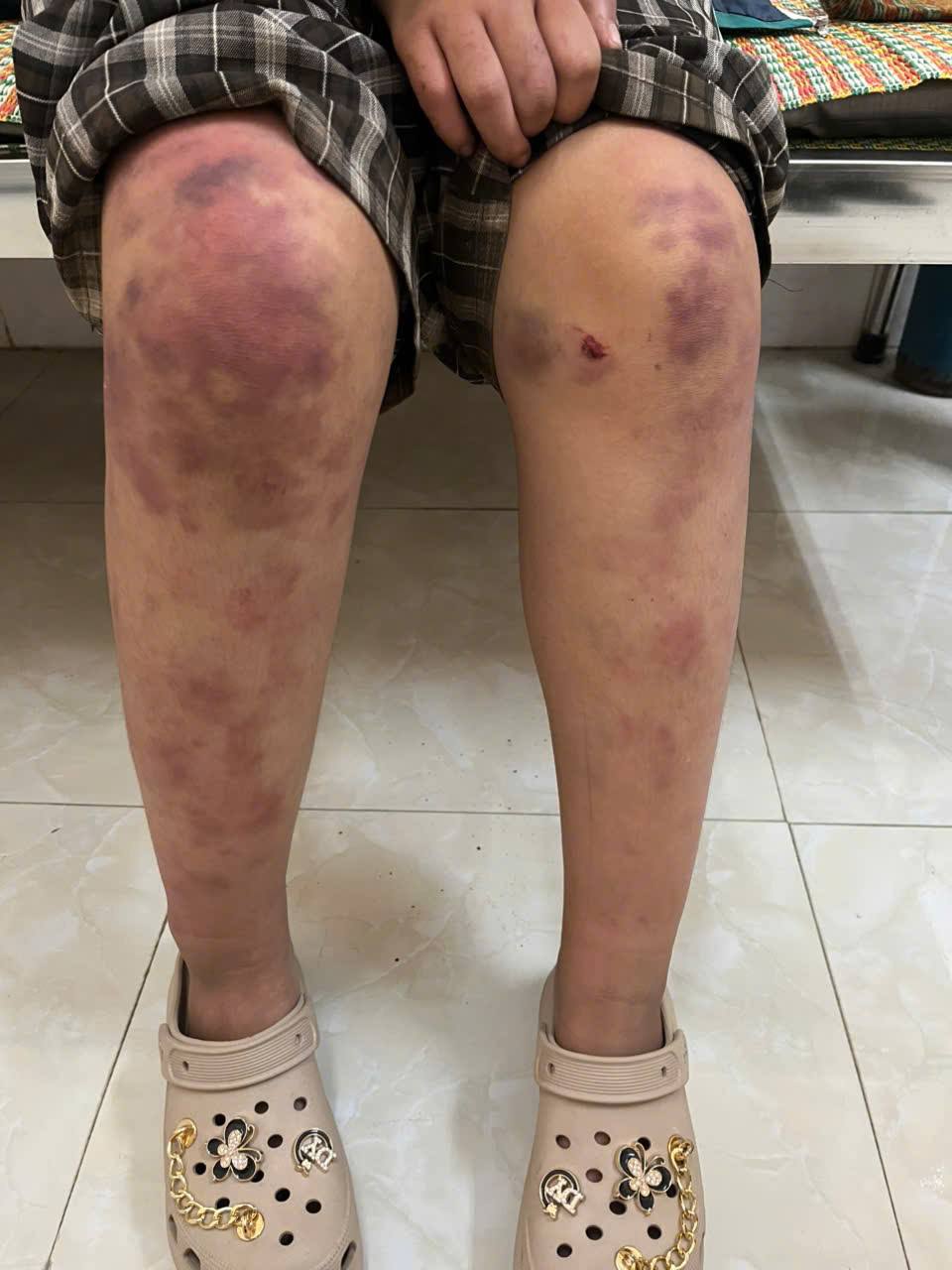 Hé lộ nguyên nhân vụ bé gái 13 tuổi bị ông bà bạo hành ở Thái Nguyên- Ảnh 1. Hé lộ nguyên nhân vụ bé gái 13 tuổi bị ông bà bạo hành ở Thái Nguyên- Ảnh 1.