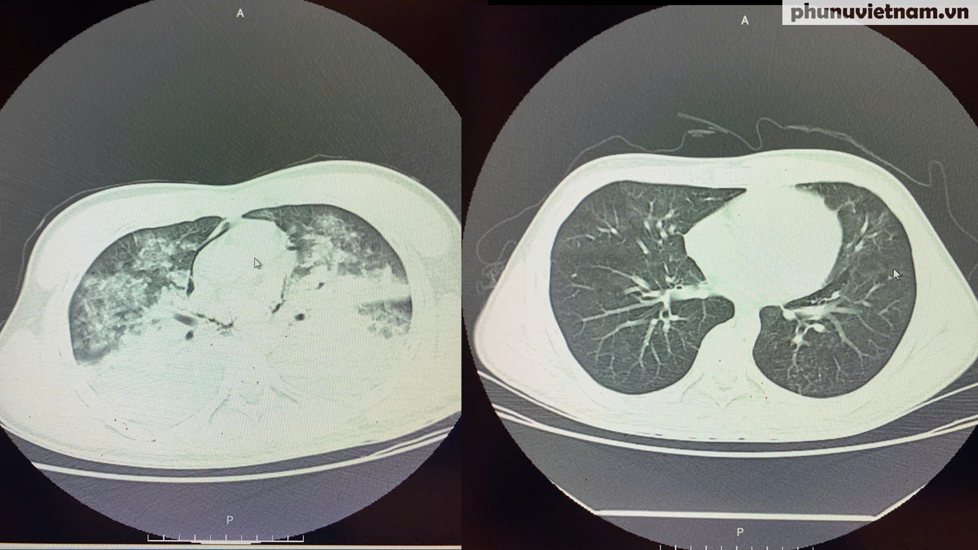 Bệnh nhân 4 lần ngừng tim hồi phục “diệu kì” sau khi đuối nước- Ảnh 1.