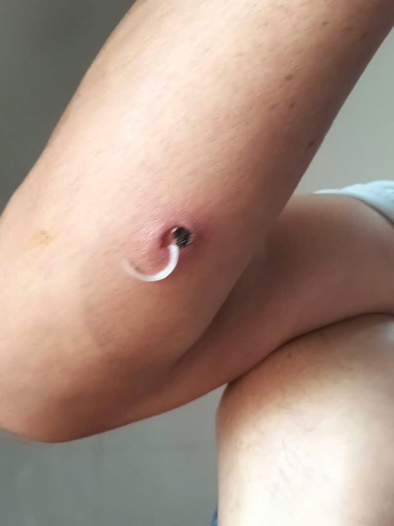 Bệnh giun rồng có chữa khỏi được không?- Ảnh 1. Bệnh giun rồng có chữa khỏi được không?- Ảnh 1.
