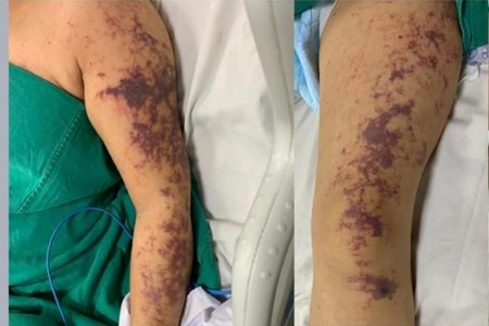Cảnh báo khẩn: Tăng cường phòng chống bệnh liên cầu lợn lây sang người- Ảnh 3.