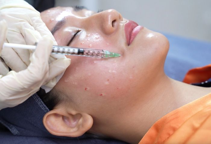 Tiêm botox khác gì với tiêm meso? So sánh để lựa chọn giải pháp làm đẹp phù hợp.- Ảnh 2.