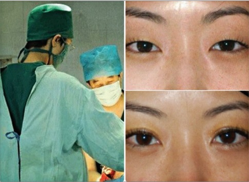 Phẫu thuật thẩm mỹ ở Trung Quốc: Thị trường 300 tỷ nhân dân tệ đang ngày càng trẻ hóa- Ảnh 2.