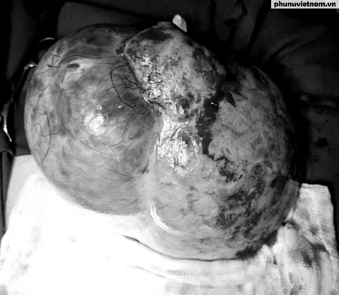 Bụng to bất thường như "sắp đẻ" vẫn không đi khám vì nghĩ béo lên- Ảnh 1. Bụng to bất thường như "sắp đẻ" vẫn không đi khám vì nghĩ béo lên- Ảnh 1.