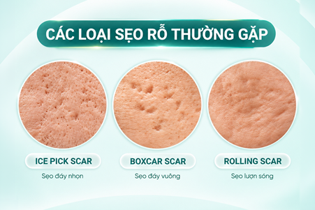 BonBoZ: Điều trị sẹo rỗ bắt đầu từ việc hiểu đúng cấu trúc sẹo- Ảnh 2.
