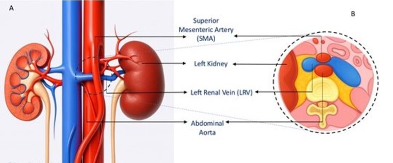 Nước tiểu có bọt bất thường, người phụ nữ đến MEDLATEC khám, phát hiện mắc hội chứng kẹp hạt dẻ hiếm gặp- Ảnh 3.