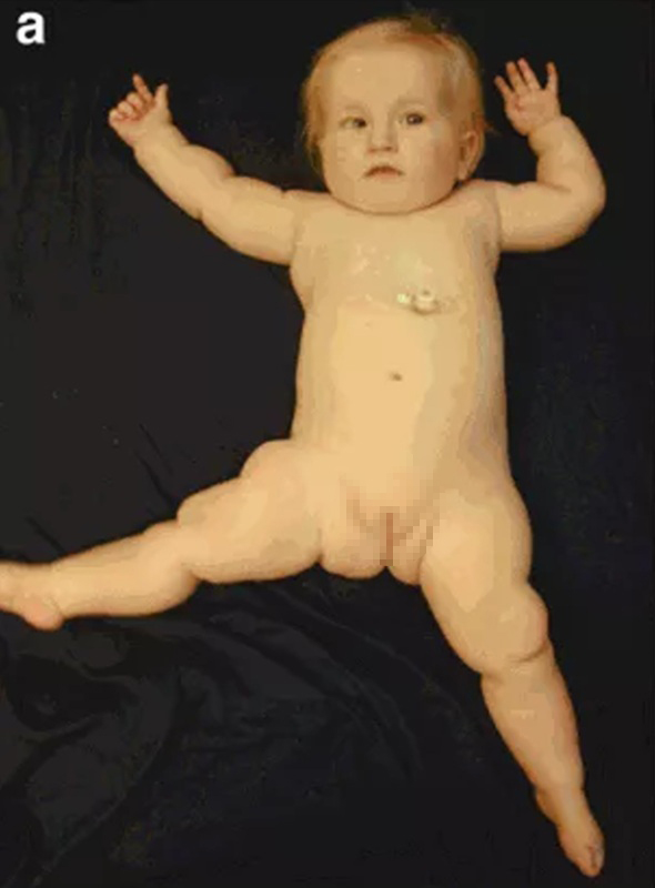 Đến MEDLATEC khám tiền hôn nhân, cặp đôi phát hiện cùng mang gen gây bệnh sinh con khó xác định giới tính- Ảnh 2.