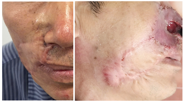 Cảnh báo ung thư da tái phát khi vết sẹo cũ thay đổi- Ảnh 2.