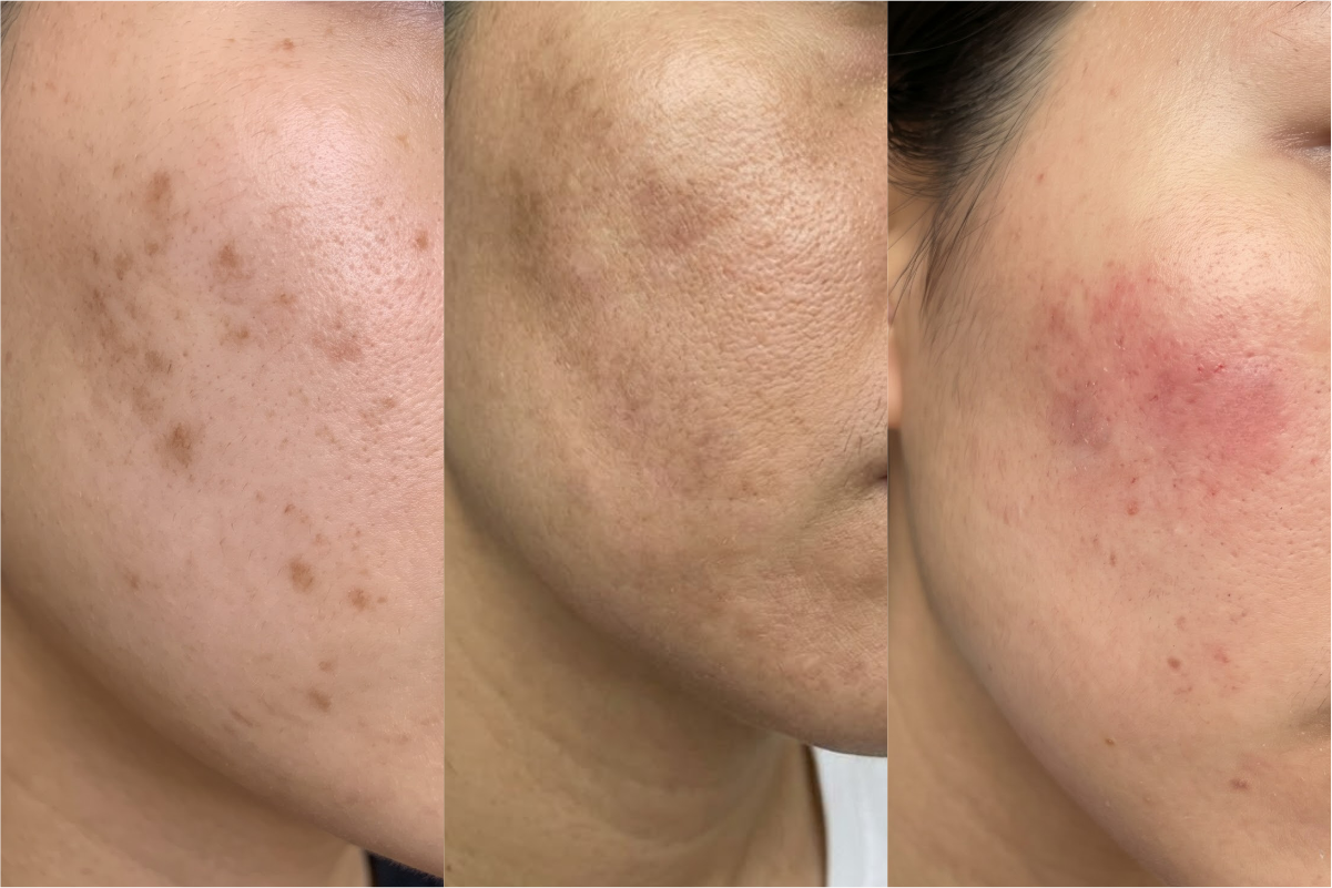ELEM FORMULAS: Serum Autophagy hỗ trợ cải thiện thâm sau mụn và sắc tố- Ảnh 3.