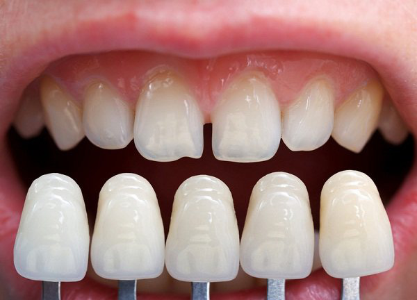 Bọc răng sứ thẩm mỹ để có hàm răng trắng và nụ cười hoàn hảo, nên hay không? - Ảnh 4.