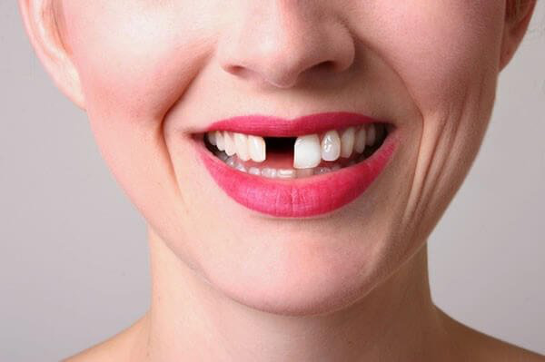 Bọc răng sứ thẩm mỹ để có hàm răng trắng và nụ cười hoàn hảo, nên hay không? - Ảnh 2.