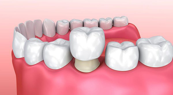 Bọc răng sứ thẩm mỹ để có hàm răng trắng và nụ cười hoàn hảo, nên hay không? - Ảnh 1.