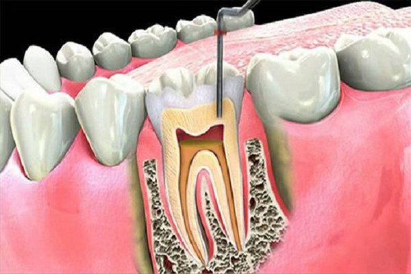 Bọc răng sứ thẩm mỹ để có hàm răng trắng và nụ cười hoàn hảo, nên hay không? - Ảnh 11.