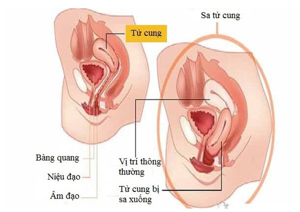 3 cách chữa sa tử cung tại nhà an toàn, hiệu quả nhanh - Ảnh 1.