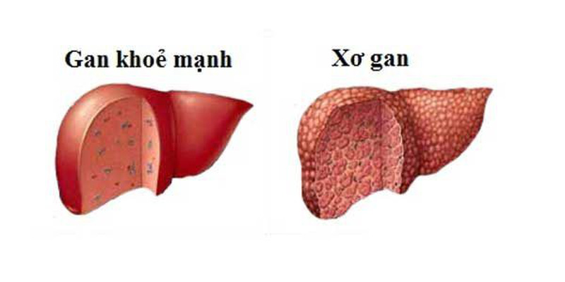 Phân độ xơ gan là gì và các dấu hiệu nhận biết xơ gan ở từng độ - Ảnh 2.