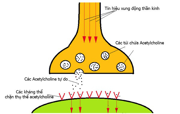 Bệnh nhược cơ - Ảnh 2.