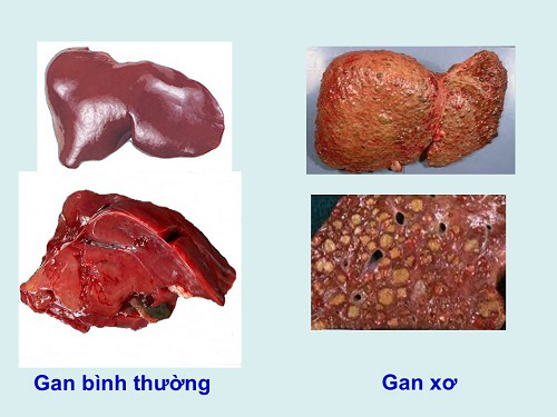 Phân độ xơ gan là gì và các dấu hiệu nhận biết xơ gan ở từng độ - Ảnh 4.