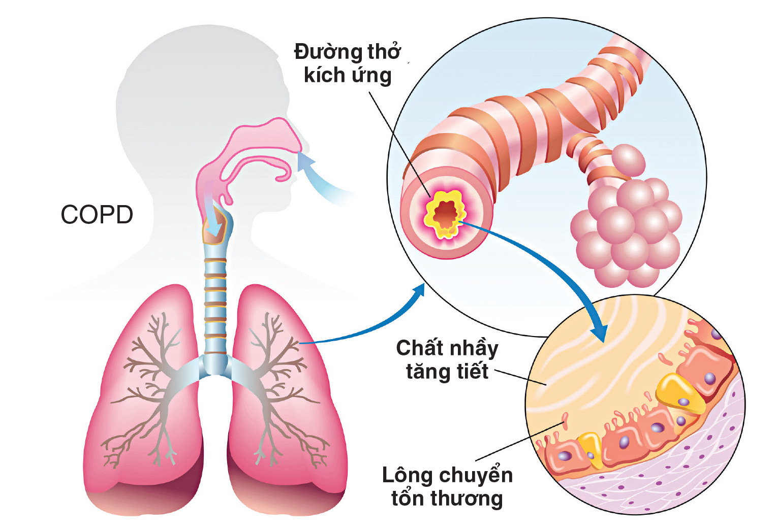 Biện pháp phục hồi chức năng cho người viêm phế quản - Ảnh 2.