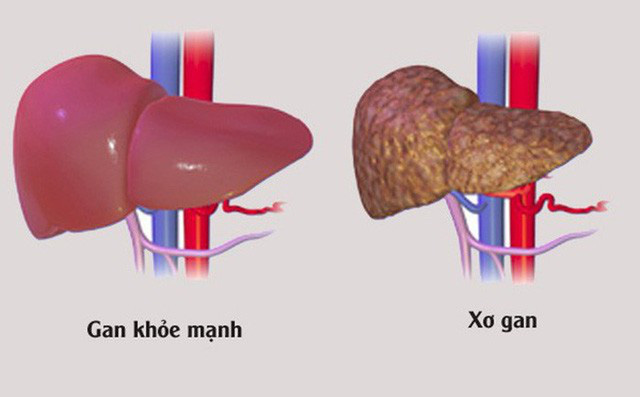 Tìm hiểu biến chứng suy gan do xơ gan - Ảnh 2.