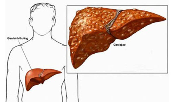 Tìm hiểu các giai đoạn của xơ gan và dấu hiệu nhận biết từng giai đoạn - Ảnh 3.