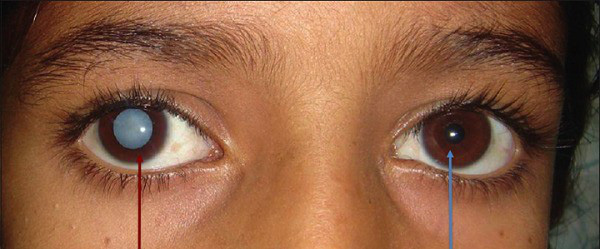 Ung thư mắt là gì? Nguyên nhân, dấu hiệu và cách điều trị bệnh - Ảnh 2.