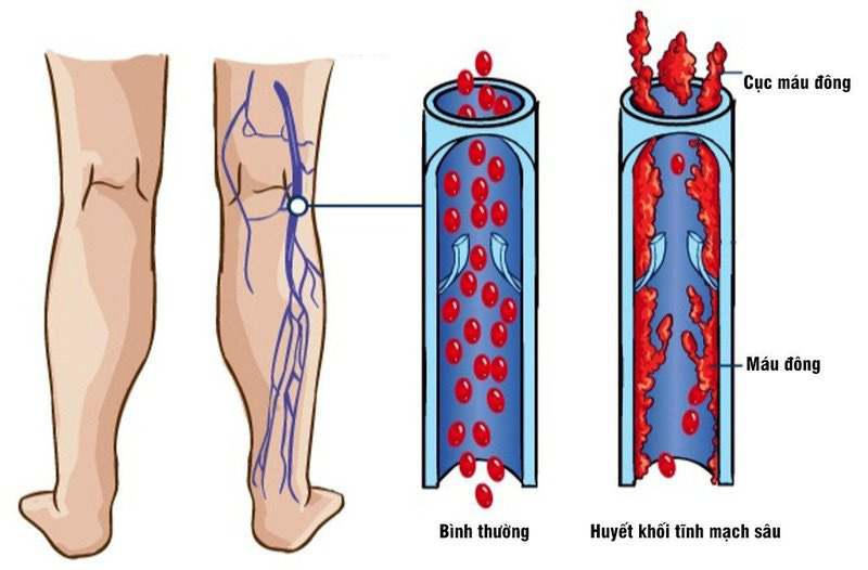 Bệnh giãn tĩnh mạch là gì-10