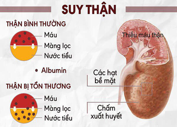 Dấu hiệu suy thận thường gặp ở nam giới và nữ giới - Ảnh 1.