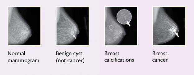 what-a-mammograph-can-show