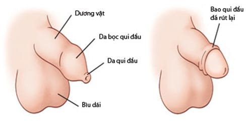 Hạ cam ở nam giới là gì? Những thông tin bạn cần biết về bệnh hạ cam - Ảnh 4.