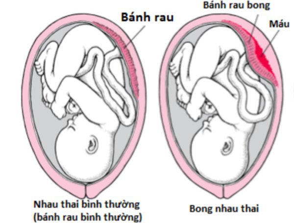 Đau bụng khi mang thai nguyên nhân do đâu? - Ảnh 5.