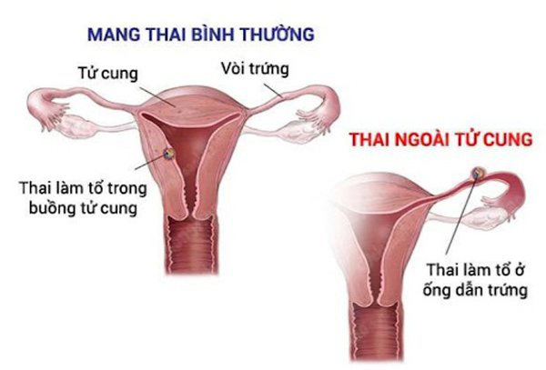 Đau bụng khi mang thai nguyên nhân do đâu? - Ảnh 3.