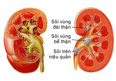 Sỏi tiết niệu