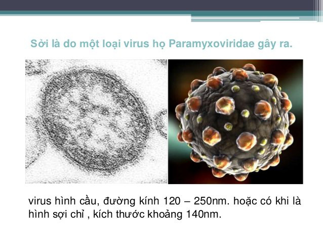 Bệnh sởi là gì? Tổng quan về bệnh sởi - Ảnh 2.