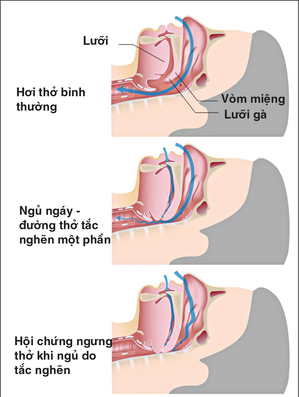 hoi-chung-ngung-tho-khi-ngu-la-gi-cach-phat-hien-va-dieu-tri-benh-som-tranh-nguy-co-tu-vong-2