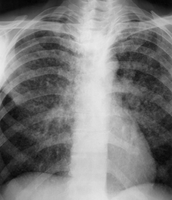 Bệnh lao ngoài phổi: Phân loại, dấu hiệu, nguyên nhân và phương pháp điều trị - Ảnh 1.